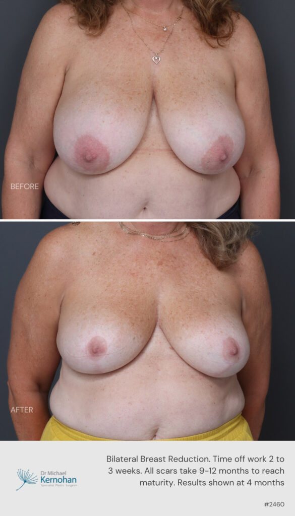 Breast Reduction Before and After -2460 Front