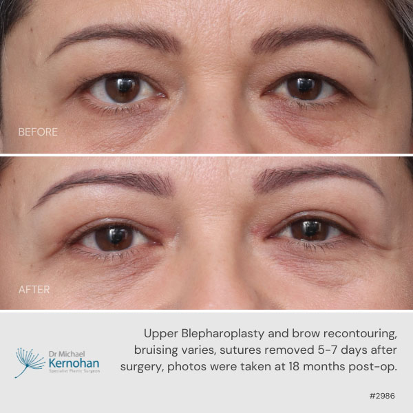 Upper blepharoplasty and brow recontouring