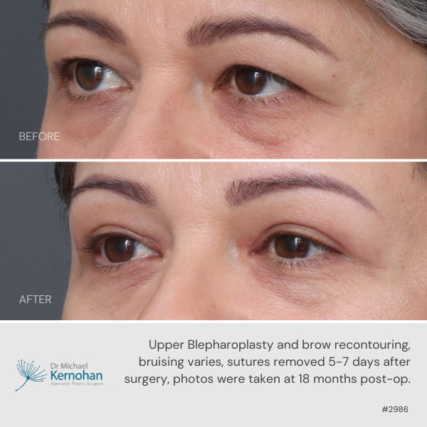 Upper blepharoplasty and brow recontouring