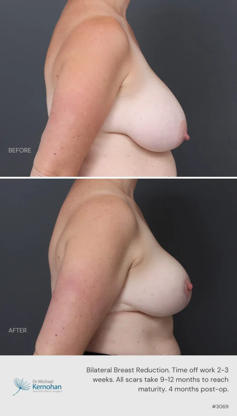 Breast Reduction Before and After Template 800 x 1200 - 3069 Breast Reduction Before and After