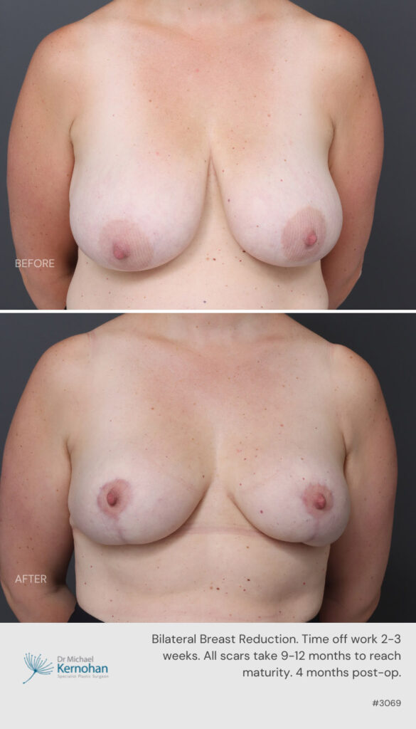 Breast Reduction Before and After