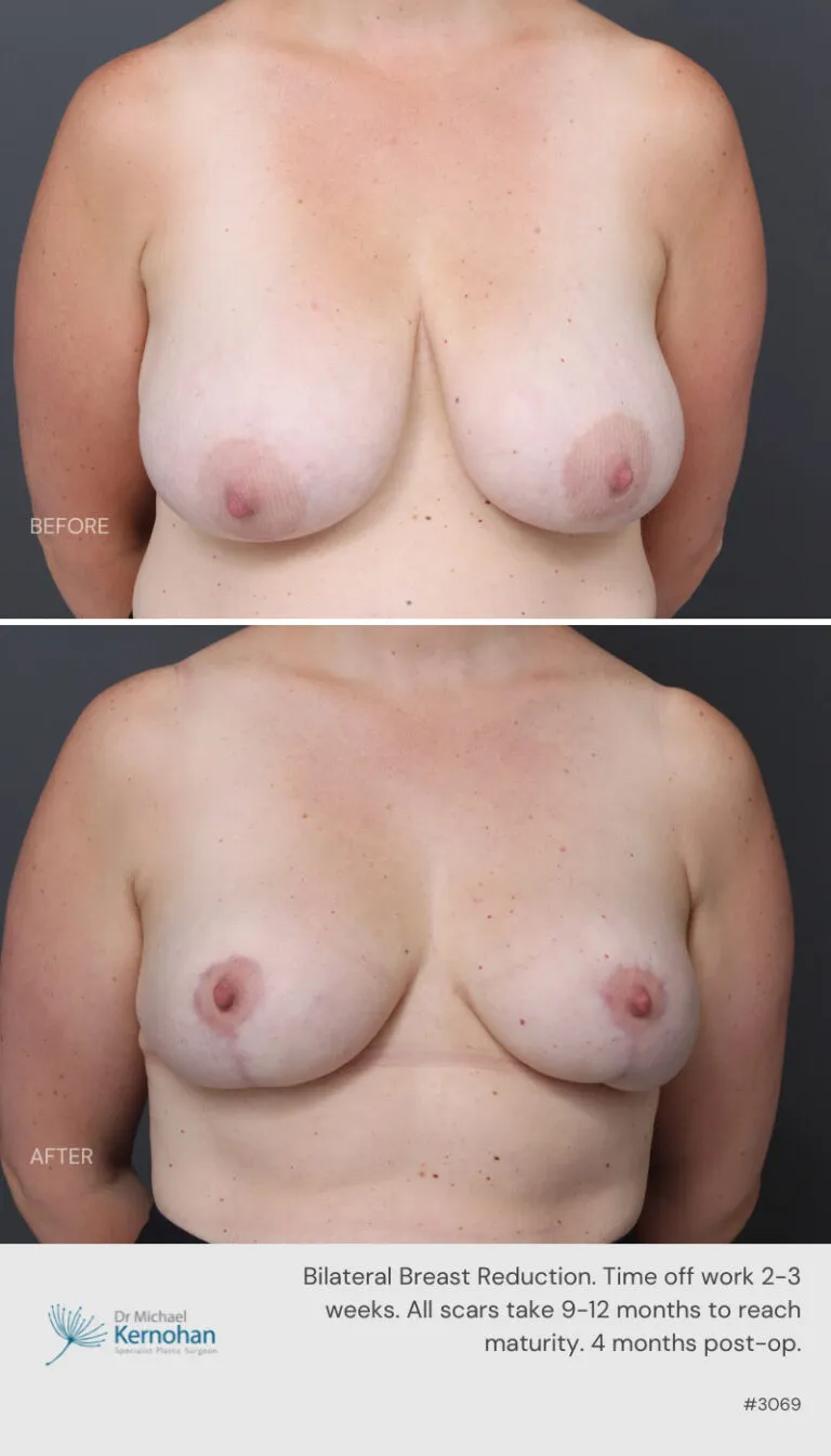 Breast Reduction Before and After Template 800 x 1200 - 3069 Breast Reduction Before and After