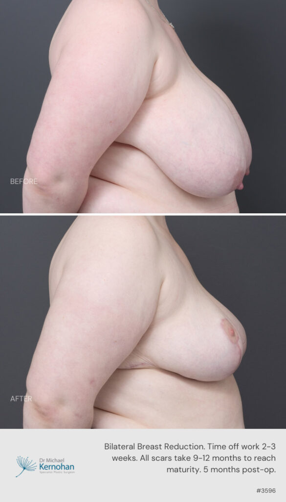 Breast Reduction Before and After - 3596 Side