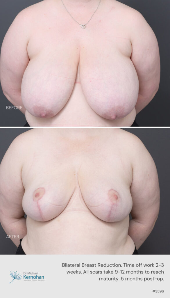 Breast Reduction Before and After - 3596 Front