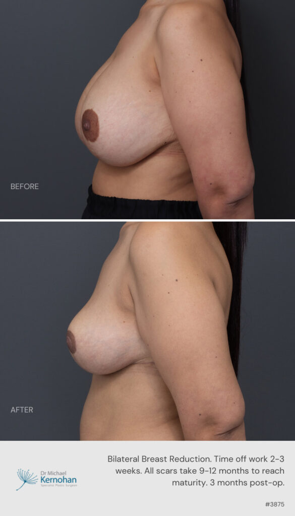 Breast Reduction Before and After -3875 Side