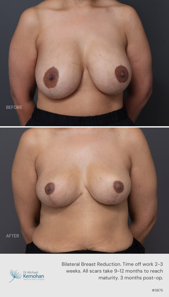 Breast Reduction Before and After - 3875 Front