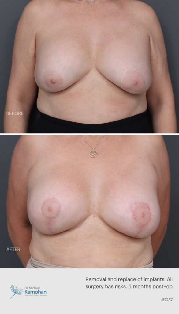 Breast Implant Exchange Before and After - 2237 Front