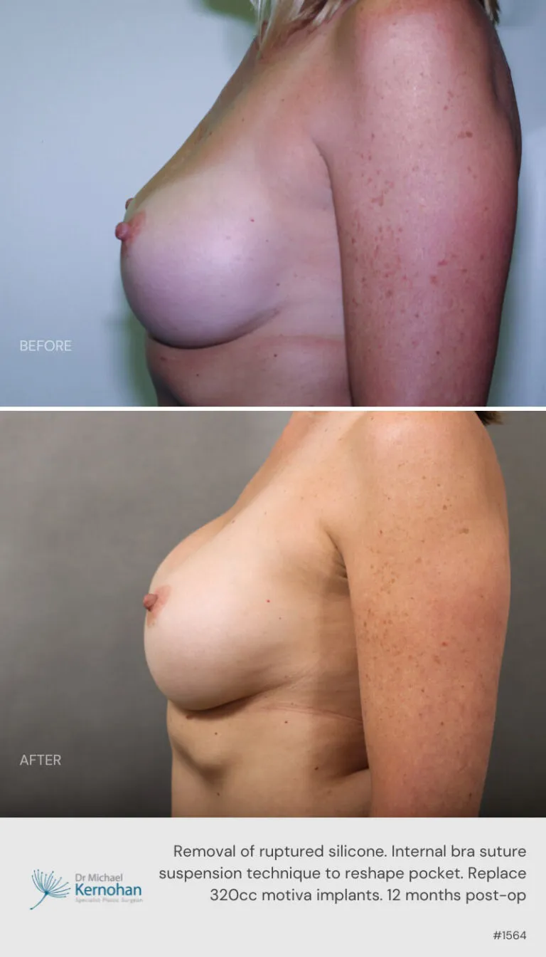 Breast Implant Exchange Before and After Breast Implant Exchange Before and After
