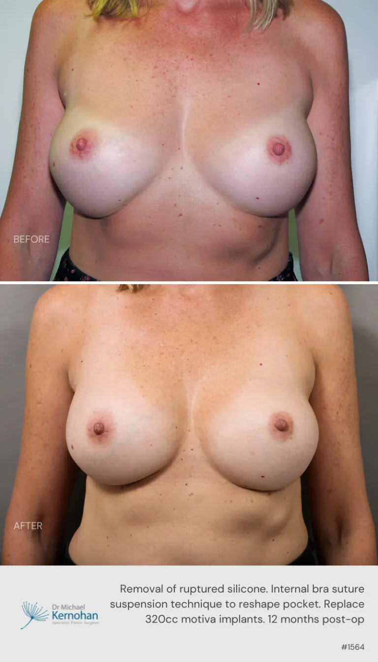 Breast Implant Exchange Before and After Breast Implant Exchange Before and After