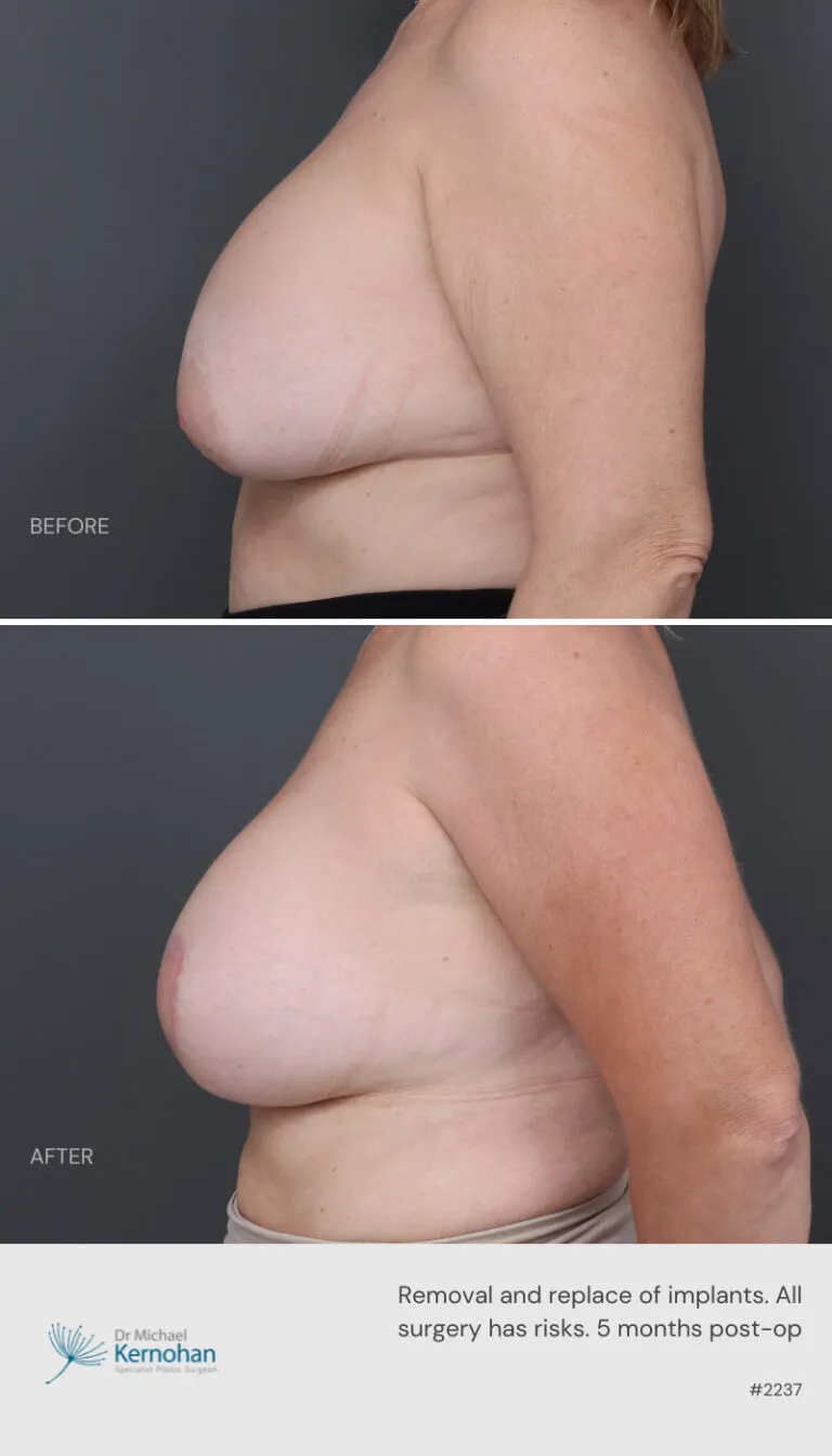 Breast Implant Exchange Before and After Breast Implant Exchange Before and After
