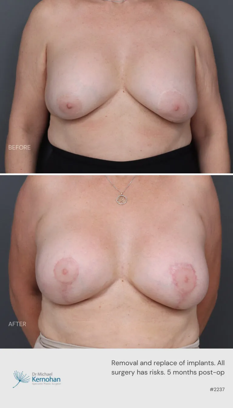 Breast Implant Exchange Before and After Breast Implant Exchange Before and After
