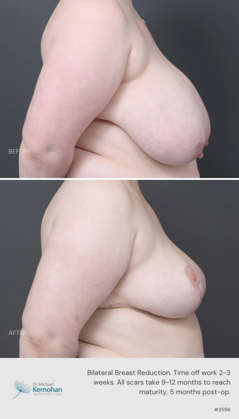 Breast Reduction Before and After Breast Reduction Before and After