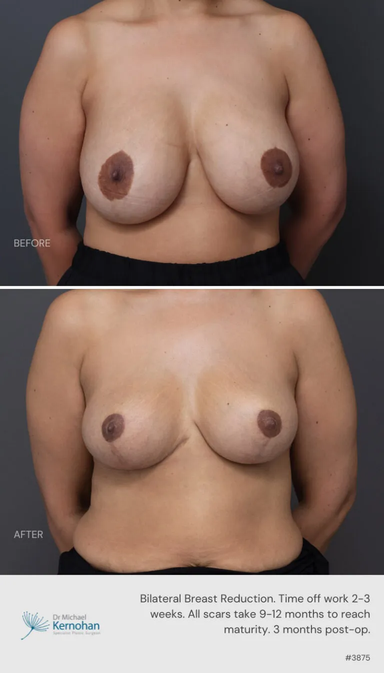 Breast Reduction Before and After Breast Reduction Before and After