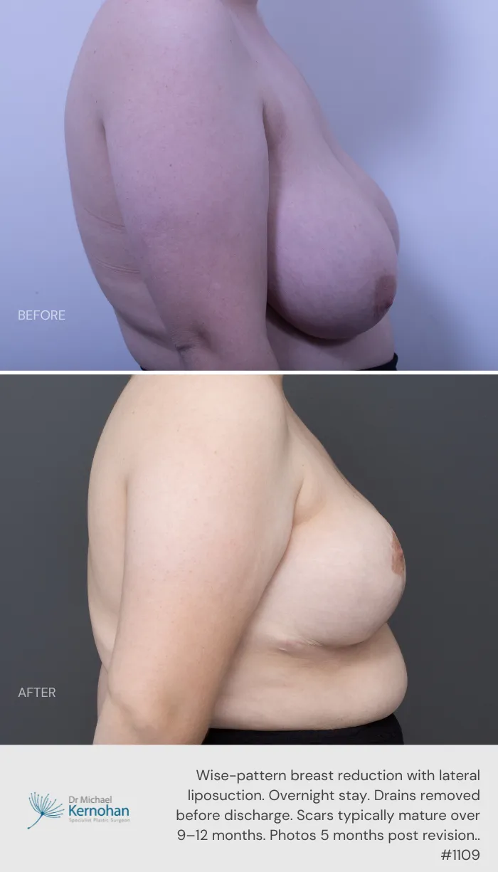 Breast Reduction Before and After Breast Reduction Before and After - 1109 Side