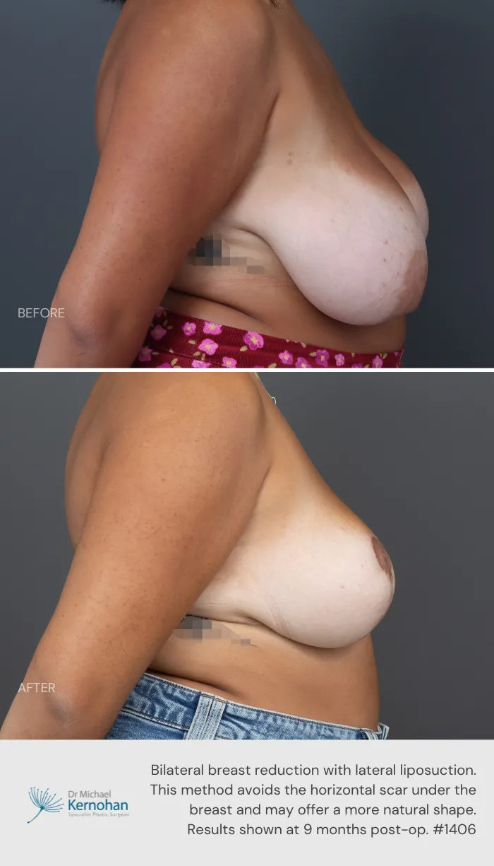Breast Reduction Before and After Breast Reduction Before and After - 1406 Side