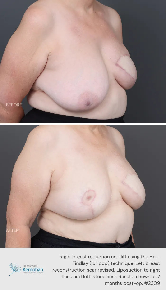 Breast Reduction Before and After Breast Reduction Before and After - 2309 45