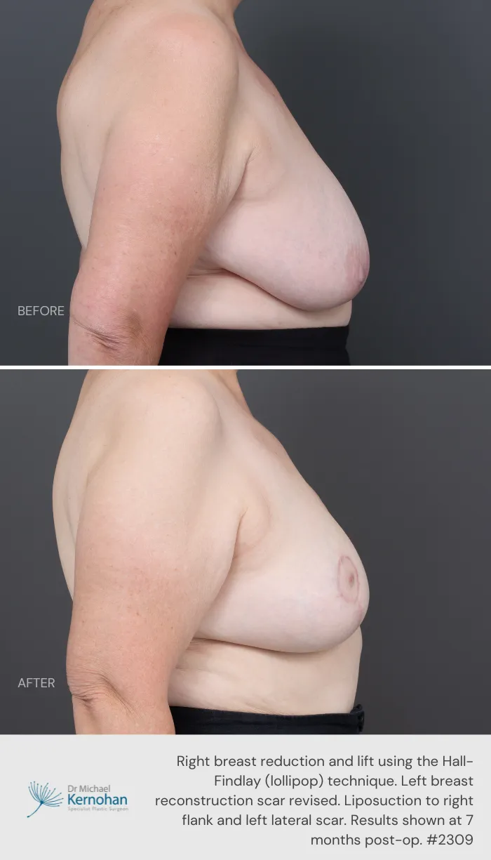 Breast Reduction Before and After Breast Reduction Before and After - 2309 Side
