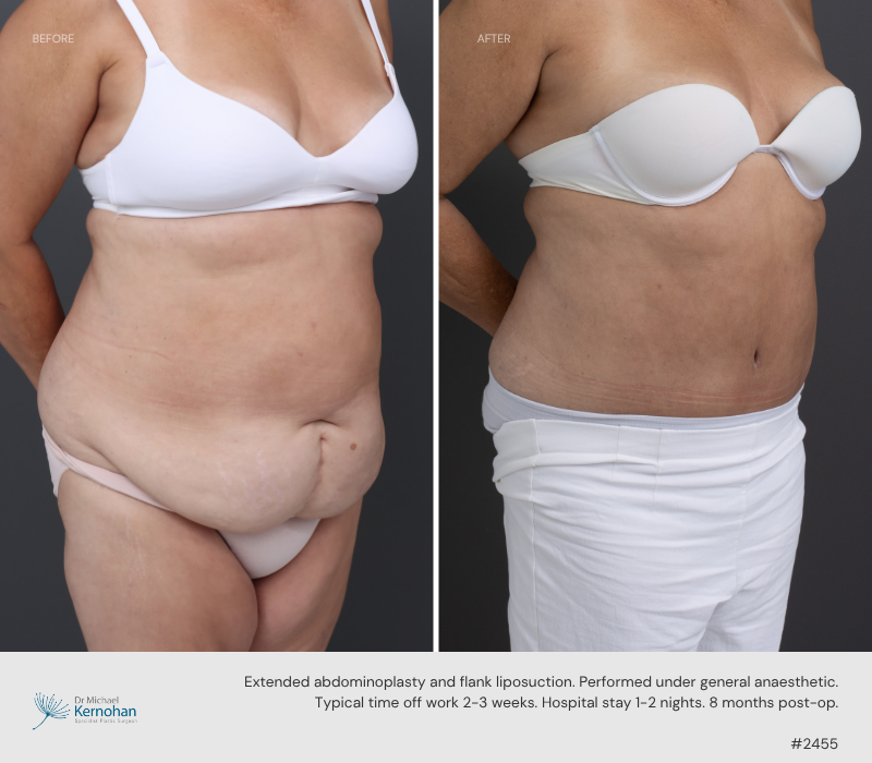 Abdominoplasty - 2455-45
