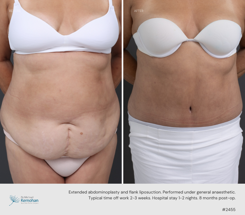 Abdominoplasty - 2455 Front