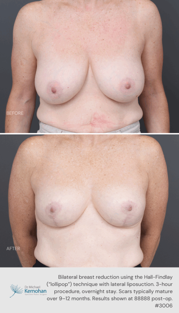 Breast Reduction Before and After