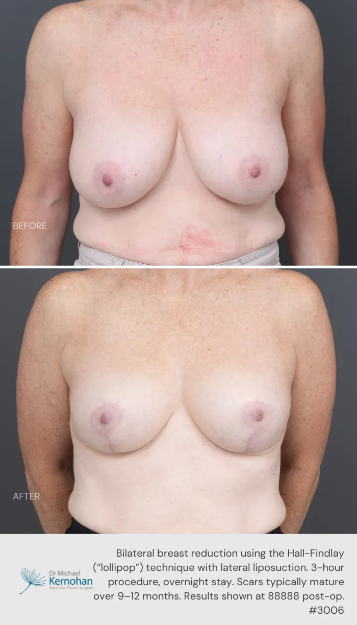 Breast Reduction Before and After Breast Reduction Before and After - 3006 Front