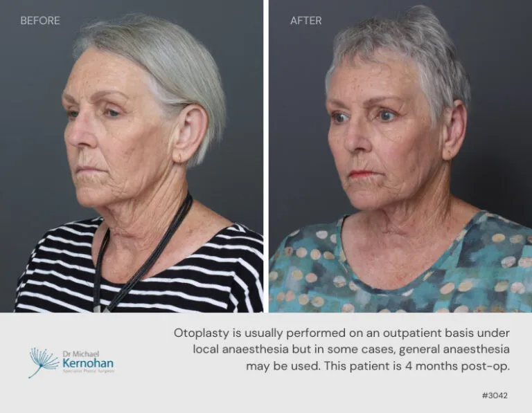 Pinnaplasty, Otoplasty, Ear Surgery Correction Before and After Pinnaplasty, Otoplasty, Ear Surgery Correction Before and After