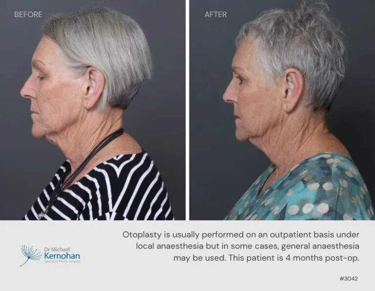 Pinnaplasty, Otoplasty, Ear Surgery Correction Before and After Pinnaplasty, Otoplasty, Ear Surgery Correction Before and After