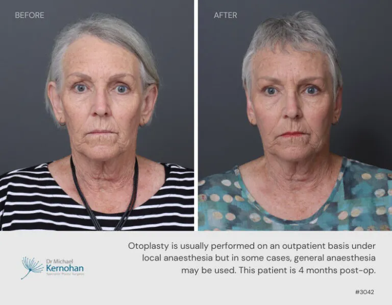 Pinnaplasty, Otoplasty, Ear Surgery Correction Before and After Pinnaplasty, Otoplasty, Ear Surgery Correction Before and After