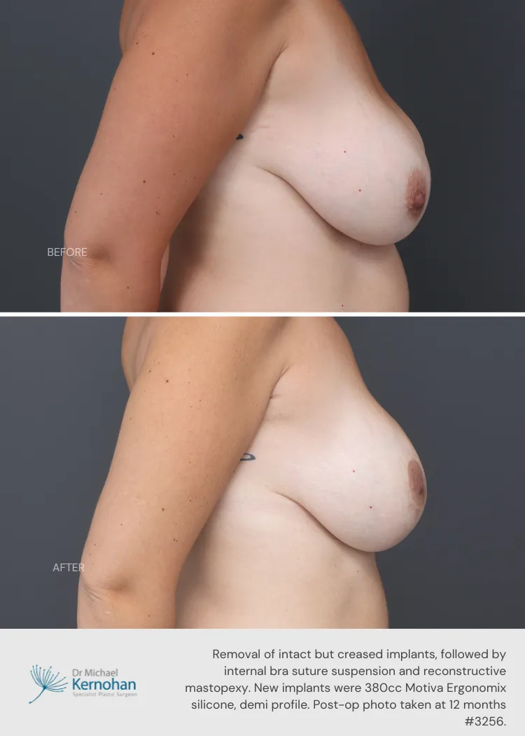 Breast Implant Exchange Before and After Breast Implant Exchange Before and After - 3256 Side