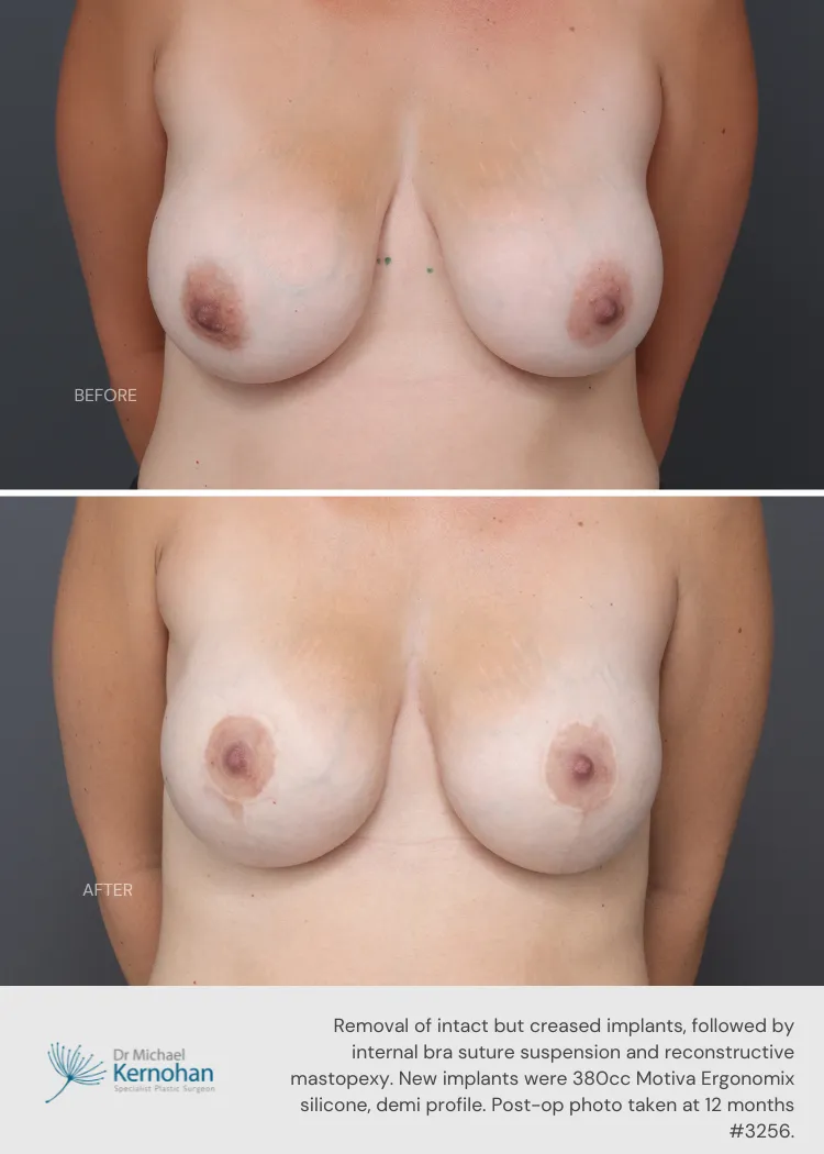 Breast Implant Exchange Before and After Breast Implant Exchange Before and After - 3256 Front