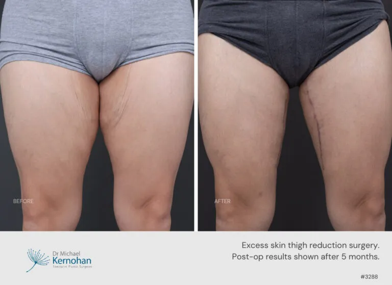 Thigh lift surgery Before and After Thigh lift surgery Before and After