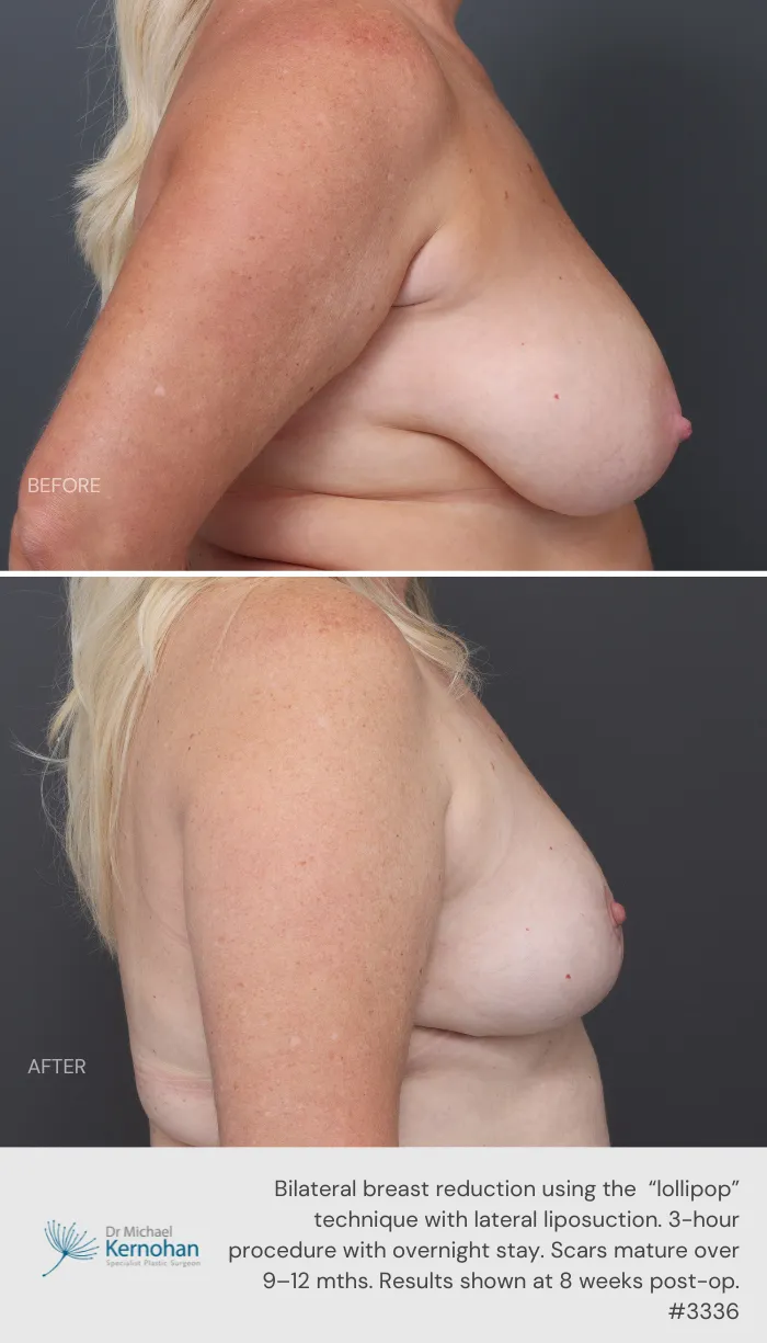 Breast Reduction Before and After Breast Reduction Before and After - 3336 Side