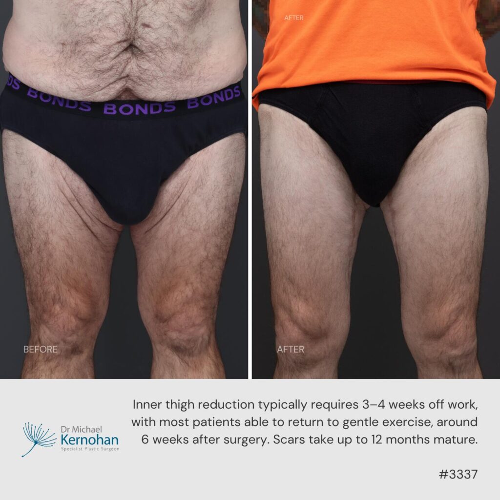 Past Patient Thigh Lift Patient 2 Before and After Gallery