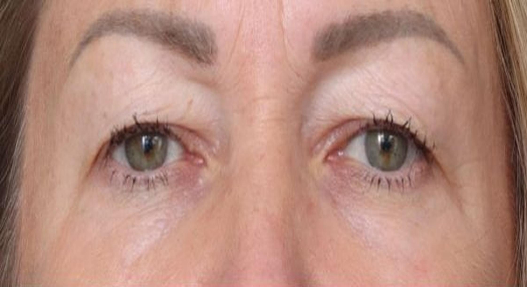 Blepharoplasty before surgery picture from actual patient