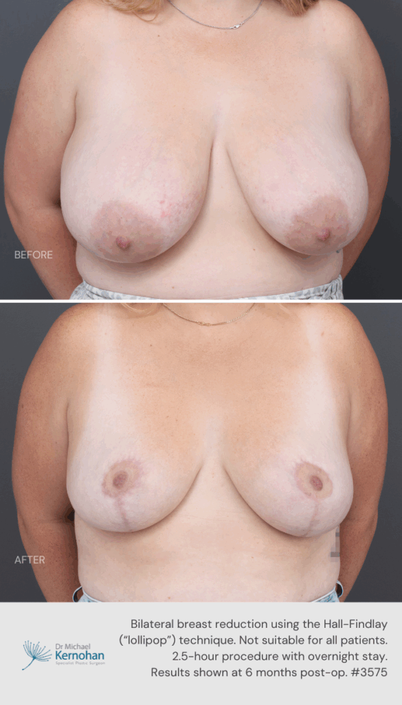 Breast Reduction Before and After