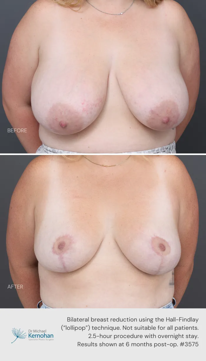 Breast Reduction Before and After Breast Reduction Before and After - 3575 Front