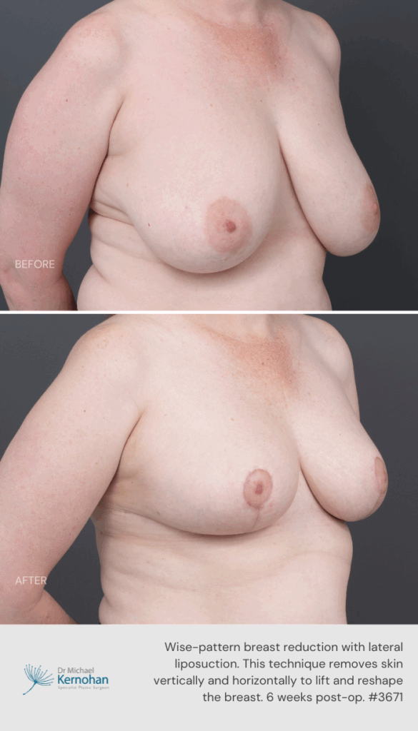 Breast Reduction Before and After