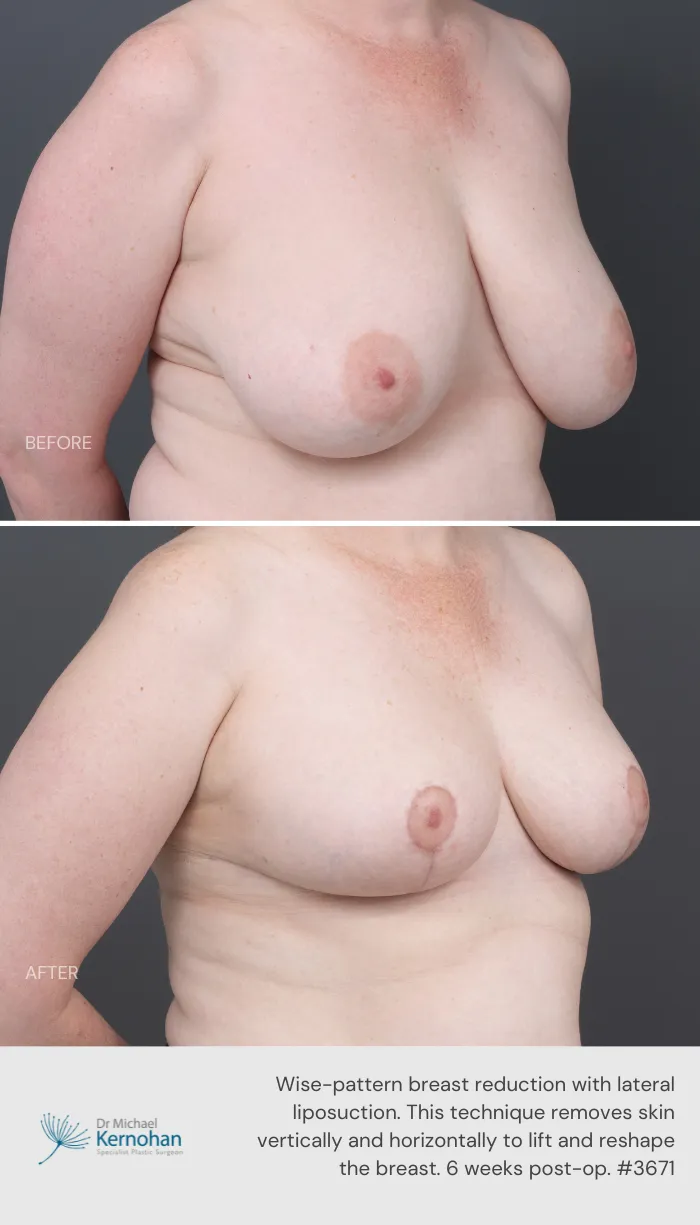 Breast Reduction Before and After Breast Reduction Before and After - 3671 45