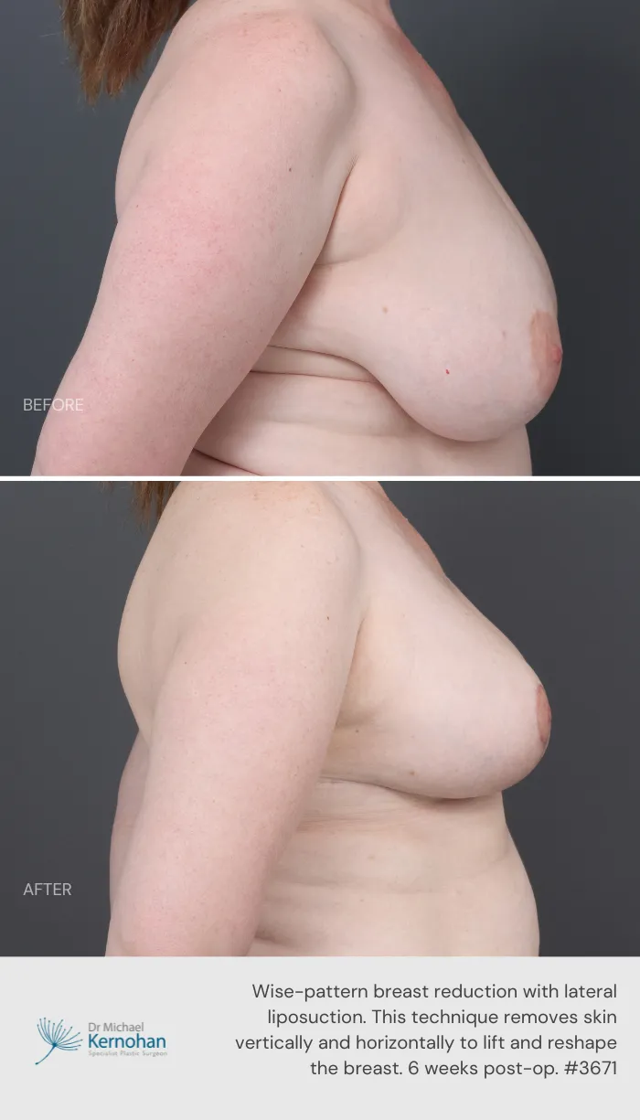 Breast Reduction Before and After Breast Reduction Before and After - 3671 Side