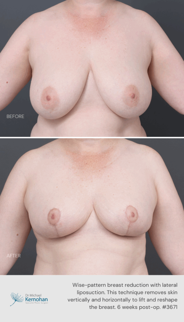 Breast Reduction Before and After