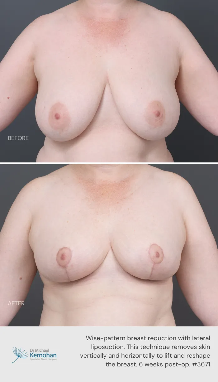 Breast Reduction Before and After Breast Reduction Before and After - 3671 Front