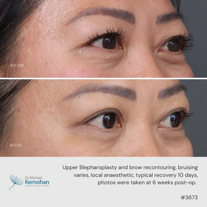 Upper blepharoplasty and brow recontouring before and after. Upper blepharoplasty and brow recontouring before and after.