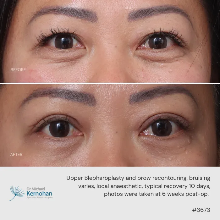 Upper blepharoplasty and brow recontouring before and after. Upper blepharoplasty and brow recontouring before and after.