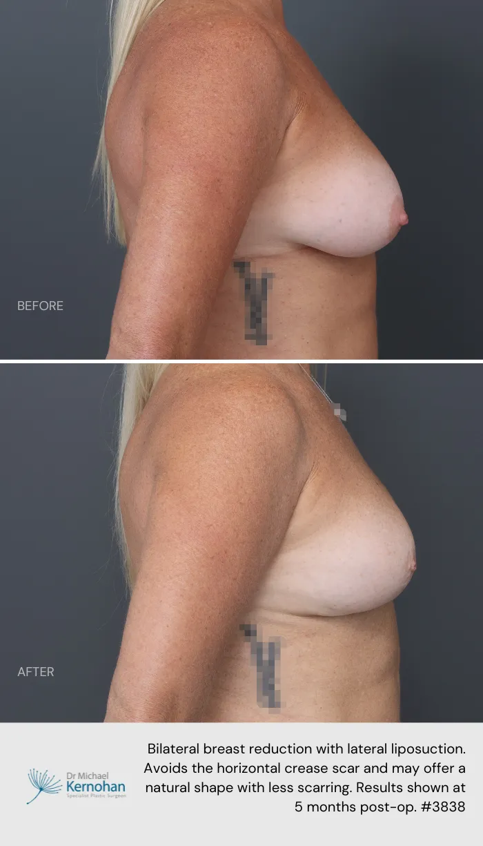 Breast Reduction Before and After Breast Reduction Before and After - 3838 Side