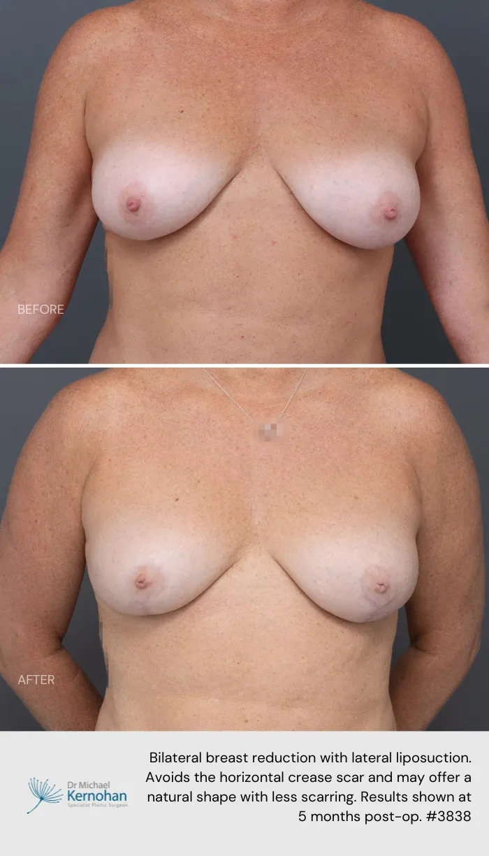 Breast Reduction Before and After Breast Reduction Before and After - 3838 Front