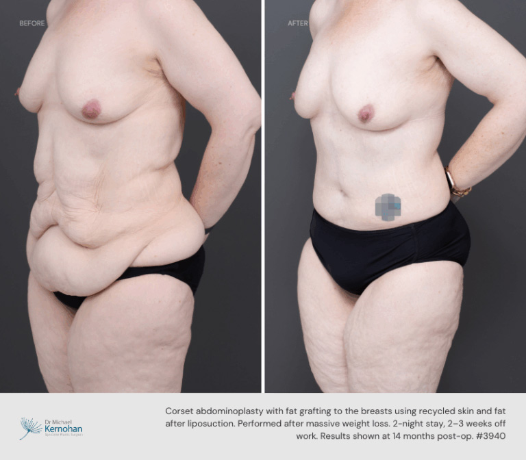 Abdominoplasty - 3940-side-Abdominoplasty Before and After I