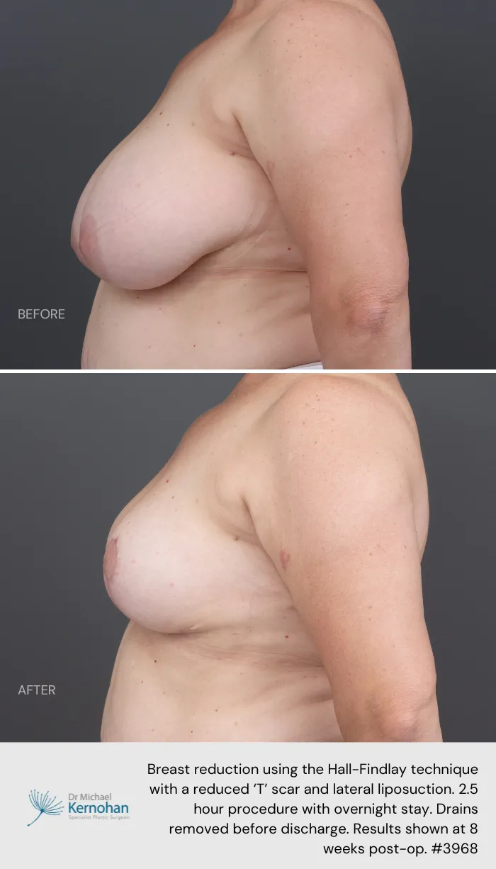 Breast Reduction Before and After Breast Reduction Before and After - 3968 Side