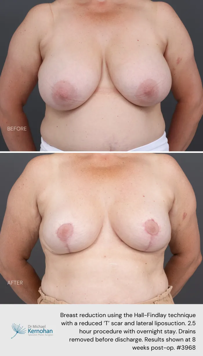 Breast Reduction Before and After Breast Reduction Before and After - 3968 Front