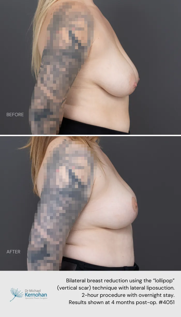 Breast Reduction Before and After Breast Reduction Before and After - 4051 Side