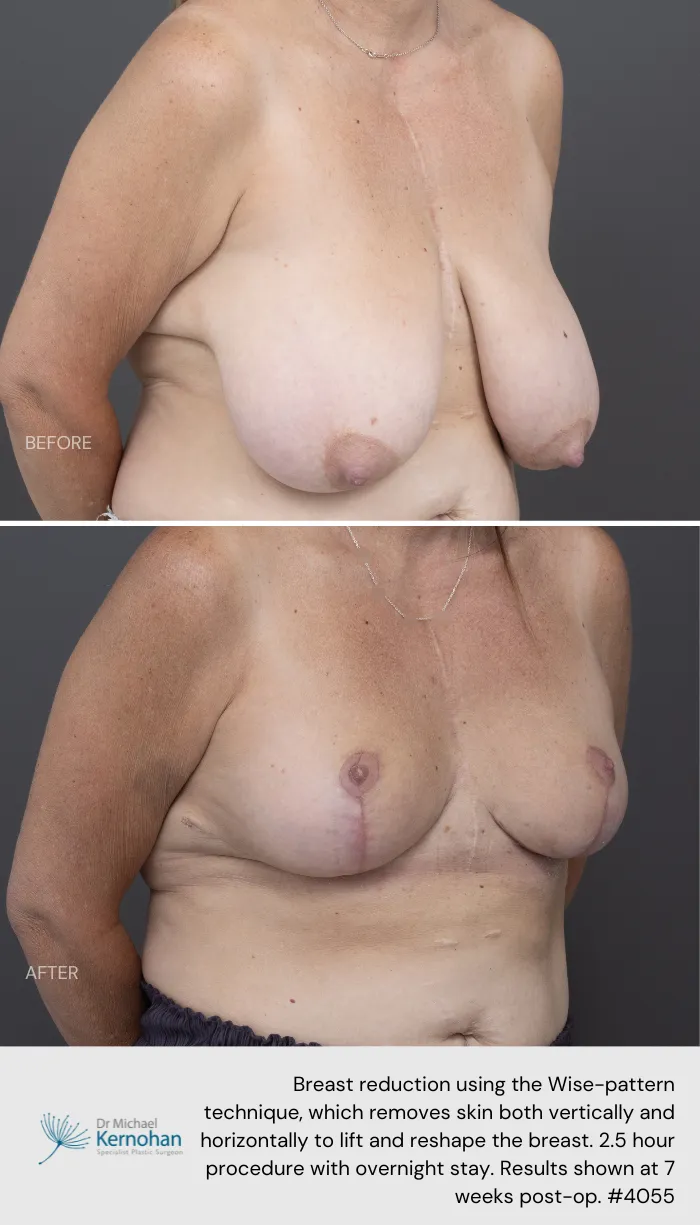 Breast Reduction Before and After Breast Reduction Before and After - 4055 45